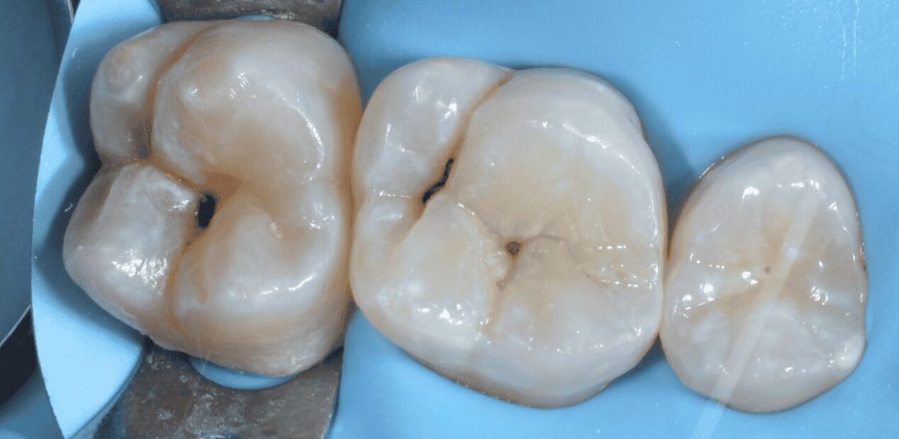 Close-up of three human molars isolated with a blue dental dam at iDental Studio dental practice in Geneva. Dental clamps hold the dam in place around the clean, healthy teeth.